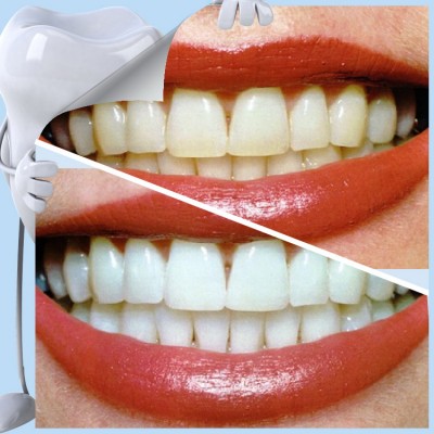 Patented best selling products in america new wholesale home private label teeth whitening kit